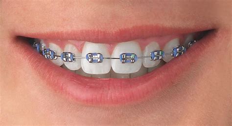 azul metalico brackets|colores de brackets modernos.